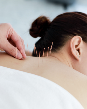 Acupuntura